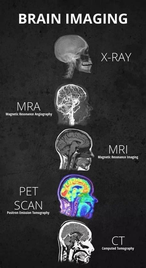 Neuroobrazowanie W Diagnostyce Neurologicznej Czyli Co I Jak Mo Na