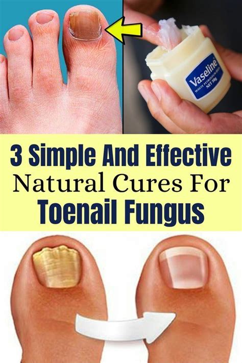 Eliminates Toenail Fungus Forever Artofit