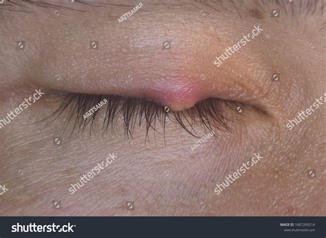 Periorbital Cellulitis