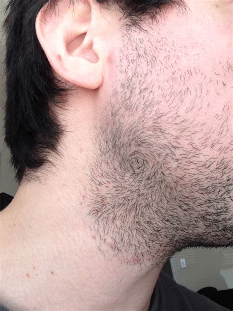 My Facial Hair Grows In A Spiral R Mildlyinteresting