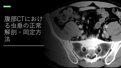 腹部ctにおける虫垂の正常解剖・同定方法 Youtube