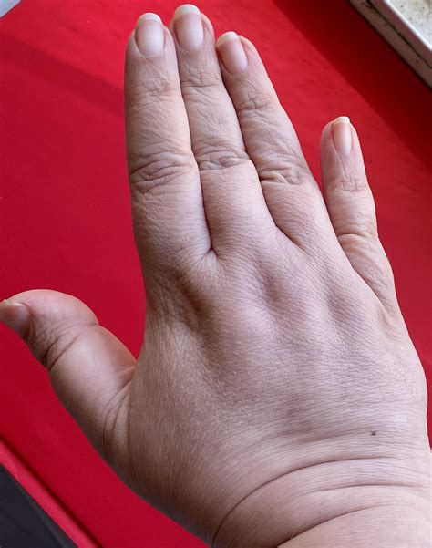 I Have Brachydactyly Types D And E Both My Thumbs Are Clubbed And 5th