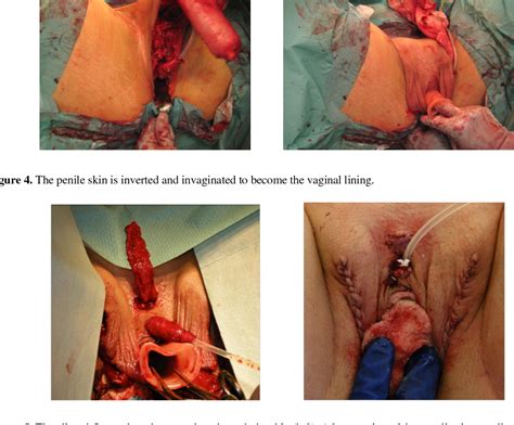 Transgender Vaginal Surgery Before And After Telegraph