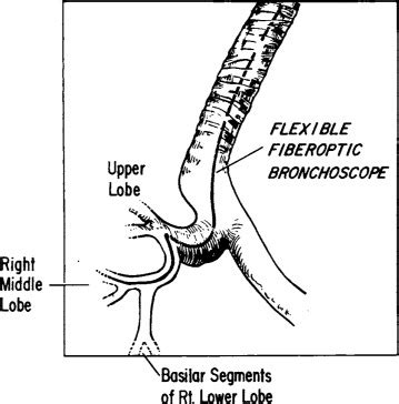 Flexible Fiberoptic Bronchoscopy - CHEST