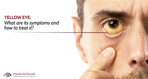 Yellow Eye: What Are Its Symptoms and How to Treat It? - Prasad Netralaya