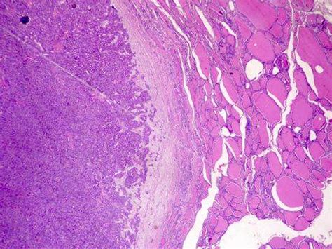 Pathology Outlines Follicular Adenoma