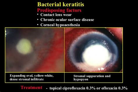 Corneal Infections