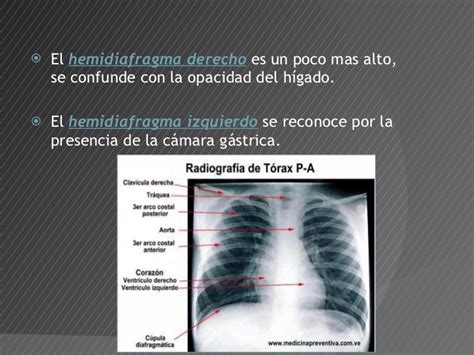 Patologias Del Diafragma Neumologia