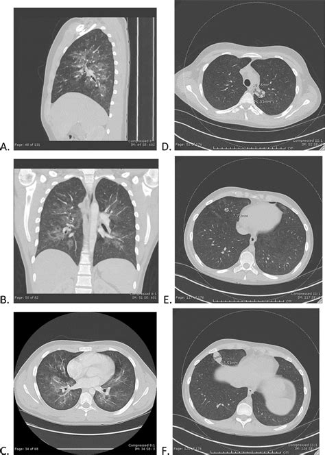 Ct Scan Findings For Patient 1 A C And Patient 2 D F A B C Ct Download Scientific