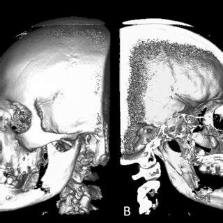 Panoramic Section From Ct Scan In Month Follow Up Highlighting An