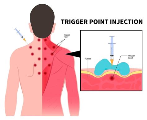 Trigger Point Injections In New Jersey Nj Pain Care Specialists