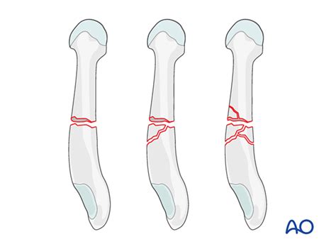 Diaphyseal Fractures Of The 5th Metatarsal