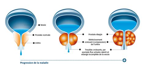 Hyperplasie De La Prostate Sympt Mes Et Traitement Granufink