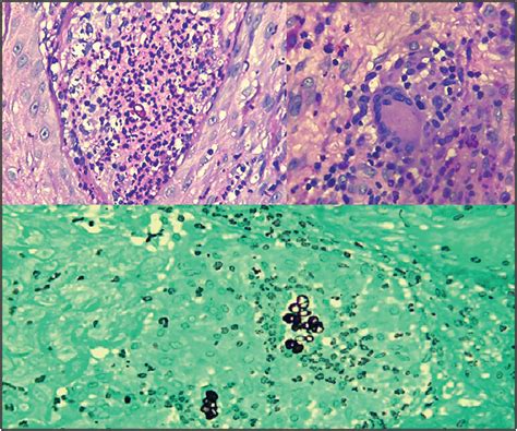 Cromoblastomicosis Verrugosa Cicatricial Multifocal Una Entidad