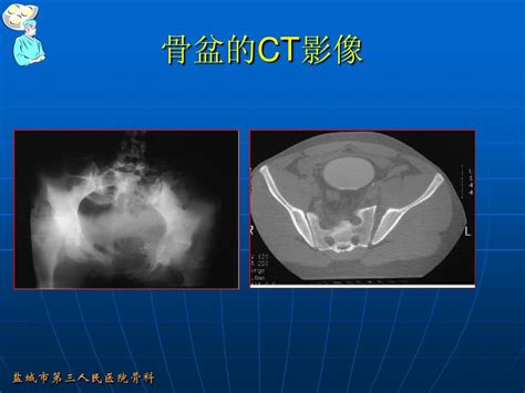 骨盆骨折的分型和治疗word文档在线阅读与下载无忧文档