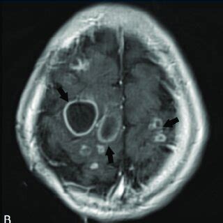 A Axial T2 Weighted Images Showing Hyperintense Lesion Arrow With