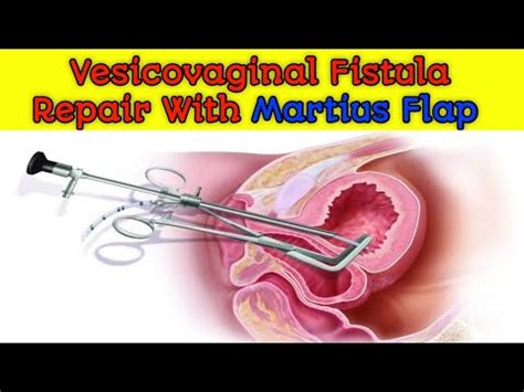 Repair Of Radiation Induced Vesicovaginal Fistula With Martius Flap