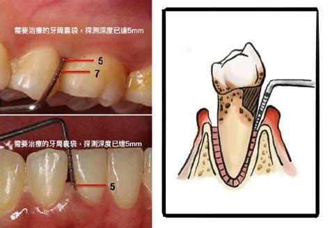 嚴重牙周病的症狀與治療程序 — 嚴重牙周病的後果是什麼？ 葉立維醫師