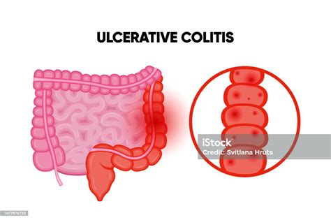 Ulcerative Colitis Inflammatory Bowel Disease Ulcer And Inflammation Of