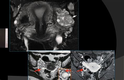 Mri In Ovarian Pathologies Part 1