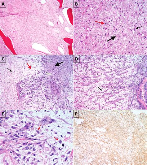 Histopathologic Examination Demonstrating A Hypocellular Tumor In