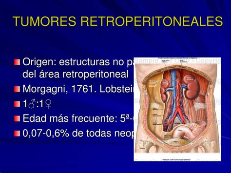 Ppt Ganglioneuroma Y Otros Tumores Retroperitoneales Primarios A