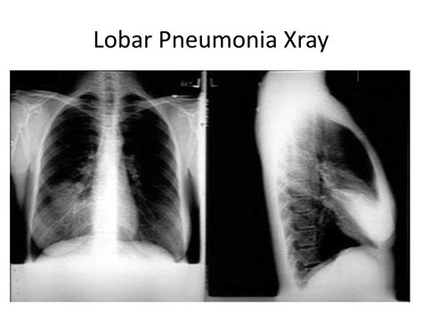 PPT - Lobar Pneumonia Xray and Generalities PowerPoint Presentation ...