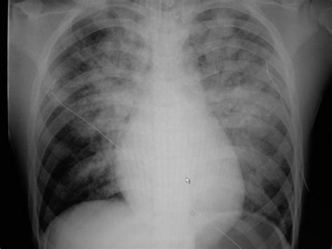 Chest x-ray showed bilateral acute pulmonary edema. | Download ...