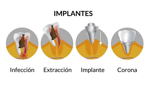 Como limpiar los implantes dentales Consejos prácticos Metódica