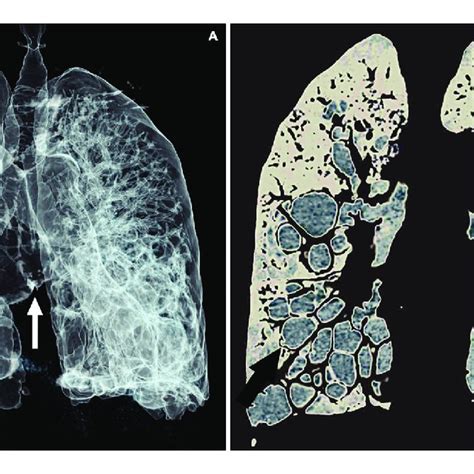 A Three Dimensional Coronal Volumetric Reconstruction Of The Airway