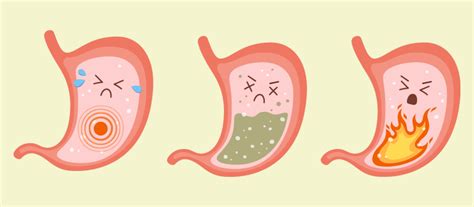 Acid Reflux Stomach Gas Causes - PELAJARAN