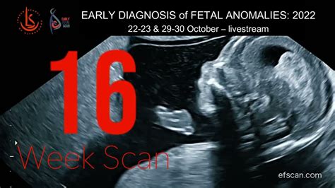 16 Week Anomaly Scan EARLY DIAGNOSIS Of FETAL ANOMALIES 2022 YouTube