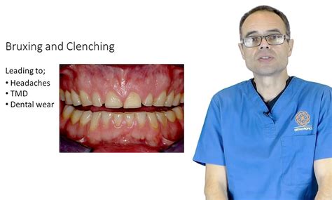 The Cause And Cure Of Bruxism And Clenching Dr Mike Mew