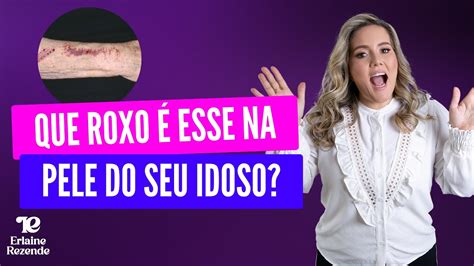 Que Roxo Esse Na Pele Do Seu Idoso Youtube