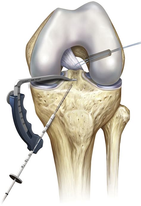 Clinical And Functional Outcome Of All Inside Anterior Cruciate Ligament Reconstruction At A