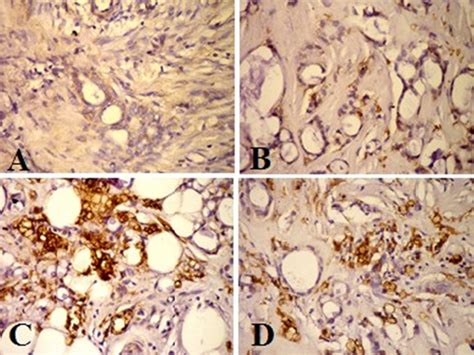 Quantitative Immunohistochemical Expression Of Gp In Invasive Ductal