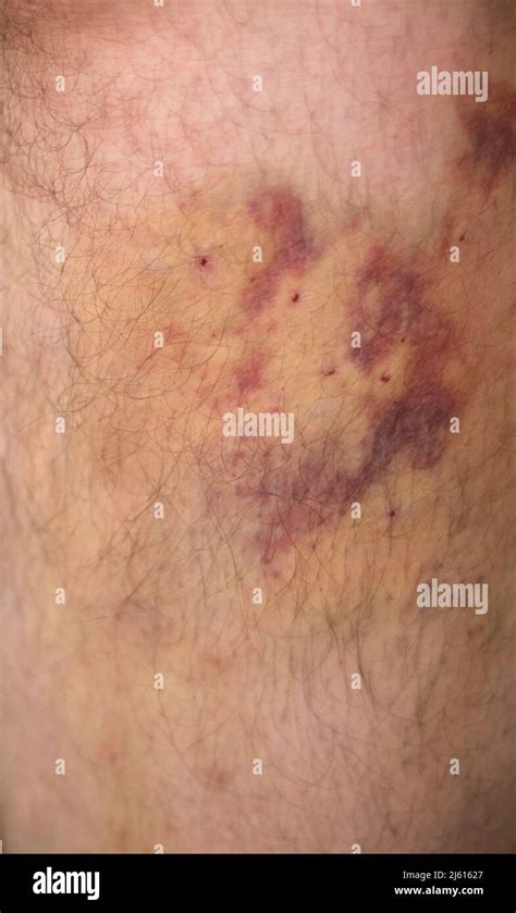 Large Hematoma On The Leg After Injections For A Medical Operation