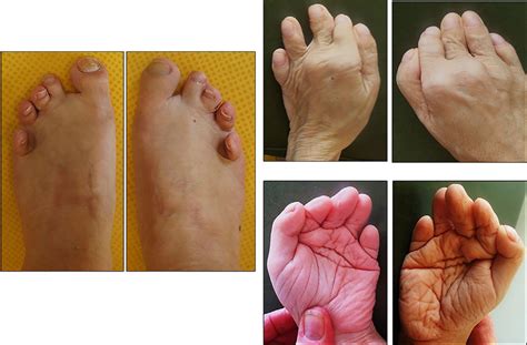 Patient 2 Hands And Feet Showed Short Toes And Fingers Sandal Gaps