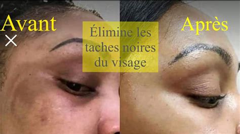 Comment se débarrasser des taches noires du visage rapidement