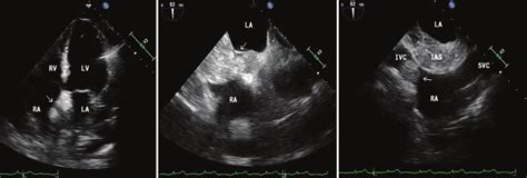 A Transthoracic Echocardiography Apical Four Chamber View Showing A