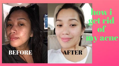 Skin Care Routine For Acne Prone Skin Gia C Lord Youtube