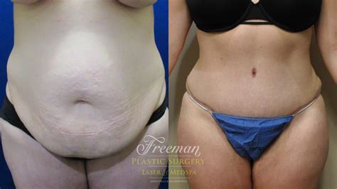 Tummy Tuck Before And After