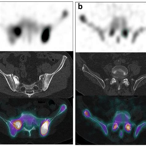 Typical examples of four types of bone metastasis. The arrow indicates ...