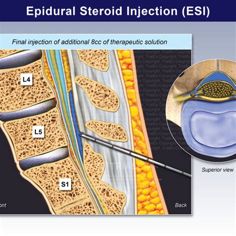 Epidural Steroid Injection Esi Trialexhibits Inc