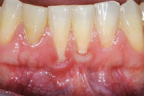 Miller Classification Of Gum Recession