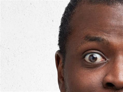 What Does Bulging Eyes Thyroid Look Like Consultants In Ophthalmic