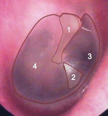 Otosclerosis Otoscopy