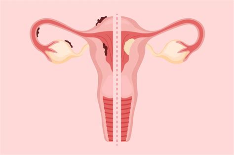 Endometriosi Guida Completa Alle Cause Sintomi E Terapie Raffaela