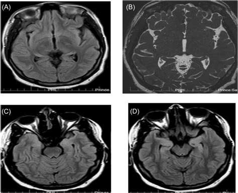 (A–D) MRI brain sections exhibiting prominent sulci, mainly of the ...