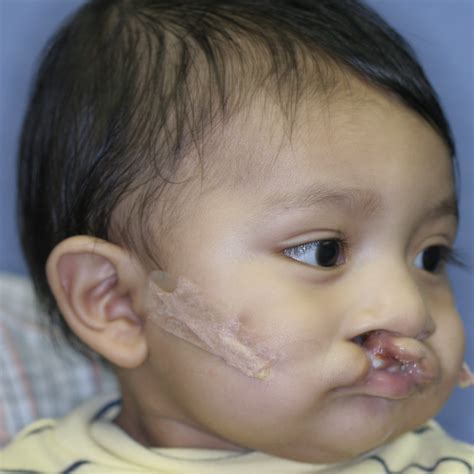 Cleft Lip And Palate Gallery Dell Childrens Craniofacial Team Of Texas